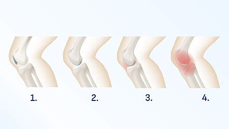 Diagram ľudského kĺbu postihnutého artrózou
