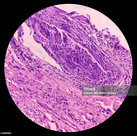 Mikroskopický pohľad na cystu