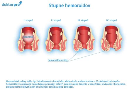 Štruktúra hemoroidov - vnútorné a vonkajšie