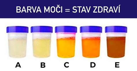 Ilustrácia rôznych odtieňov moču od svetložltej po tmavú jantárovú