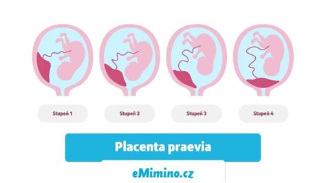 Infografika porovnávajúca rôzne typy placenty praevia.