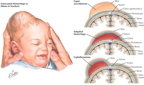 Opuch hlavičky novorodenca (Caput succedaneum)