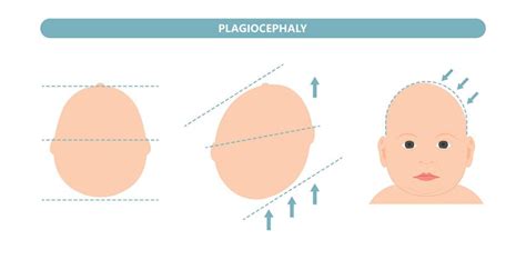 Schematické znázornenie plagiocefálie
