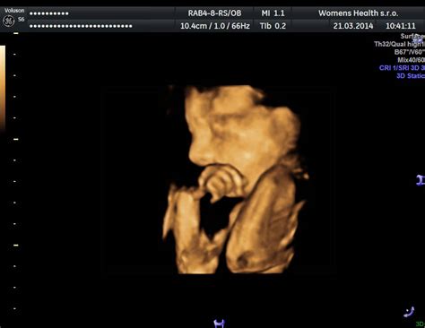 Ultrazvukové zobrazenie dvojčiat