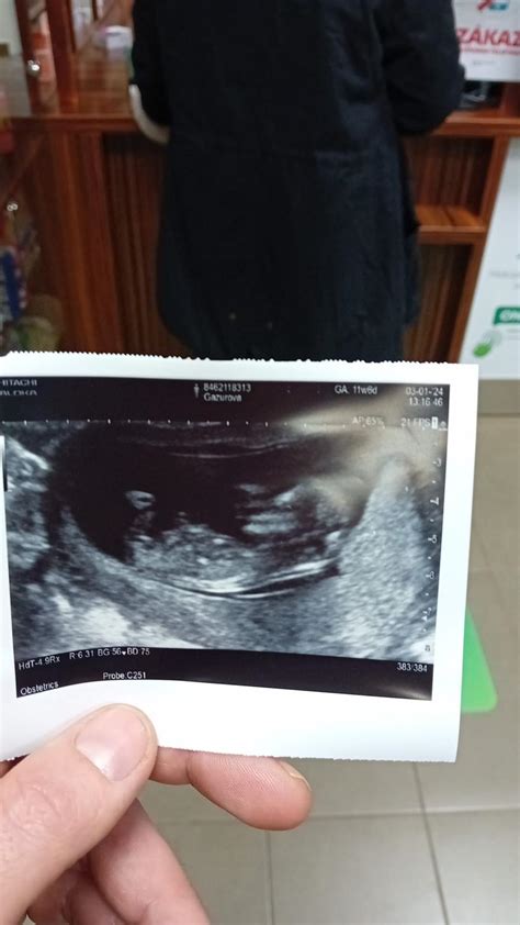 ultrazvuk bábätka v 34. týždni